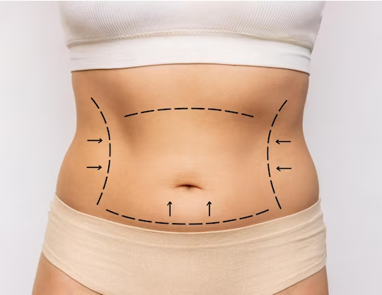 From Dreams to Reality: Miami’s Expertise in Transformative Tummy Tucks post thumbnail image
